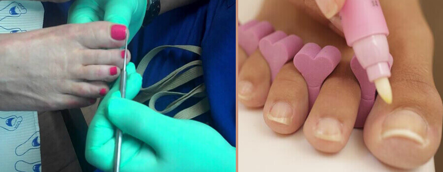 diy toe nail cleaner