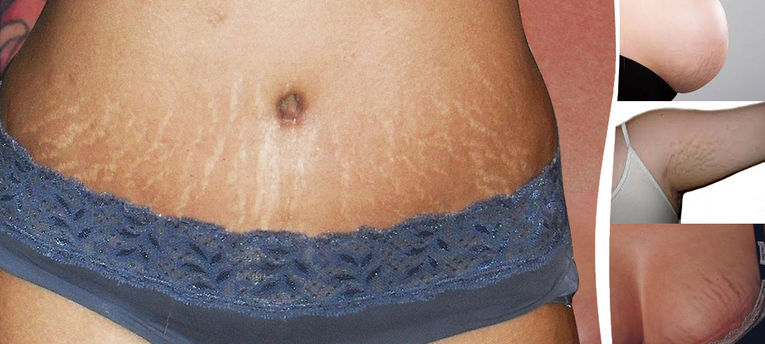 How to remove stretch marks naturally.