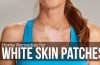 white skin patches