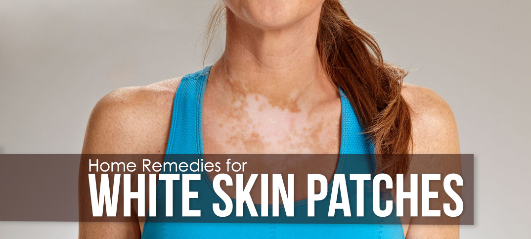 white skin patches