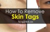 remove skin tags and moles