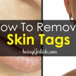 remove skin tags and moles